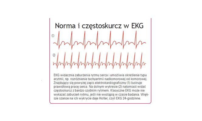 Zdjęcie lub grafika przedstawiająca EKG z przyspieszonym rytmem serca.